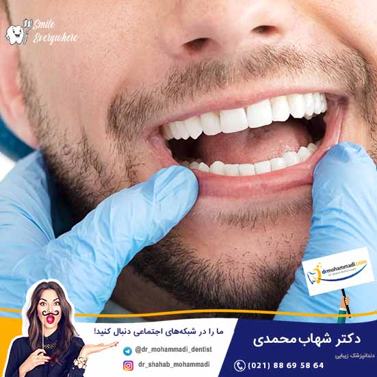 بلیچینگ دندان خوبه؟ - کلینیک دندانپزشکی دکتر شهاب محمدی